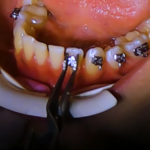 خطوات تركيب تقويم الاسنان - موقع تقويم الاسنان