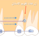 .زرعات تقويم الاسنان