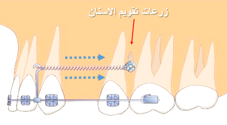 .زرعات تقويم الاسنان